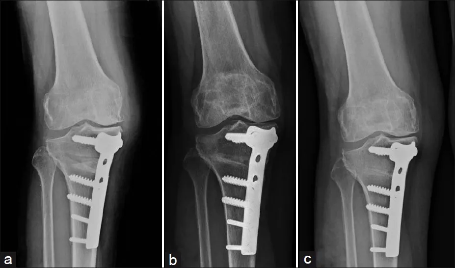 High tibial osteotomy