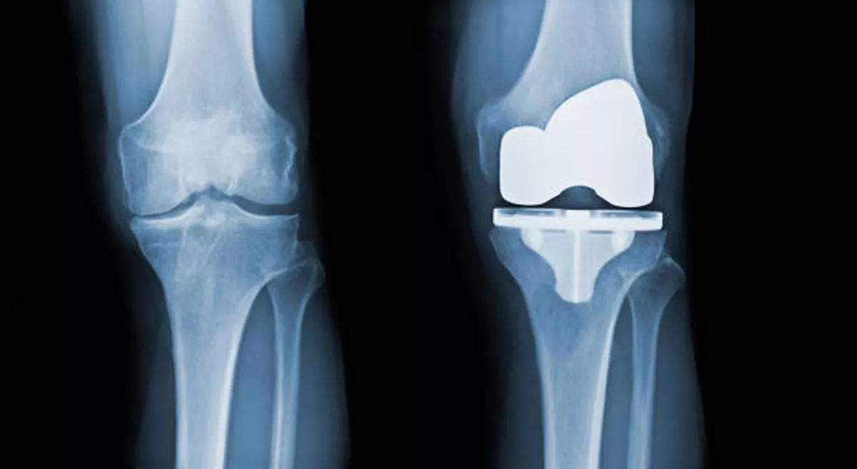 Knee Replacement Surgery,dysfunctional Knee,orthopedic treatment