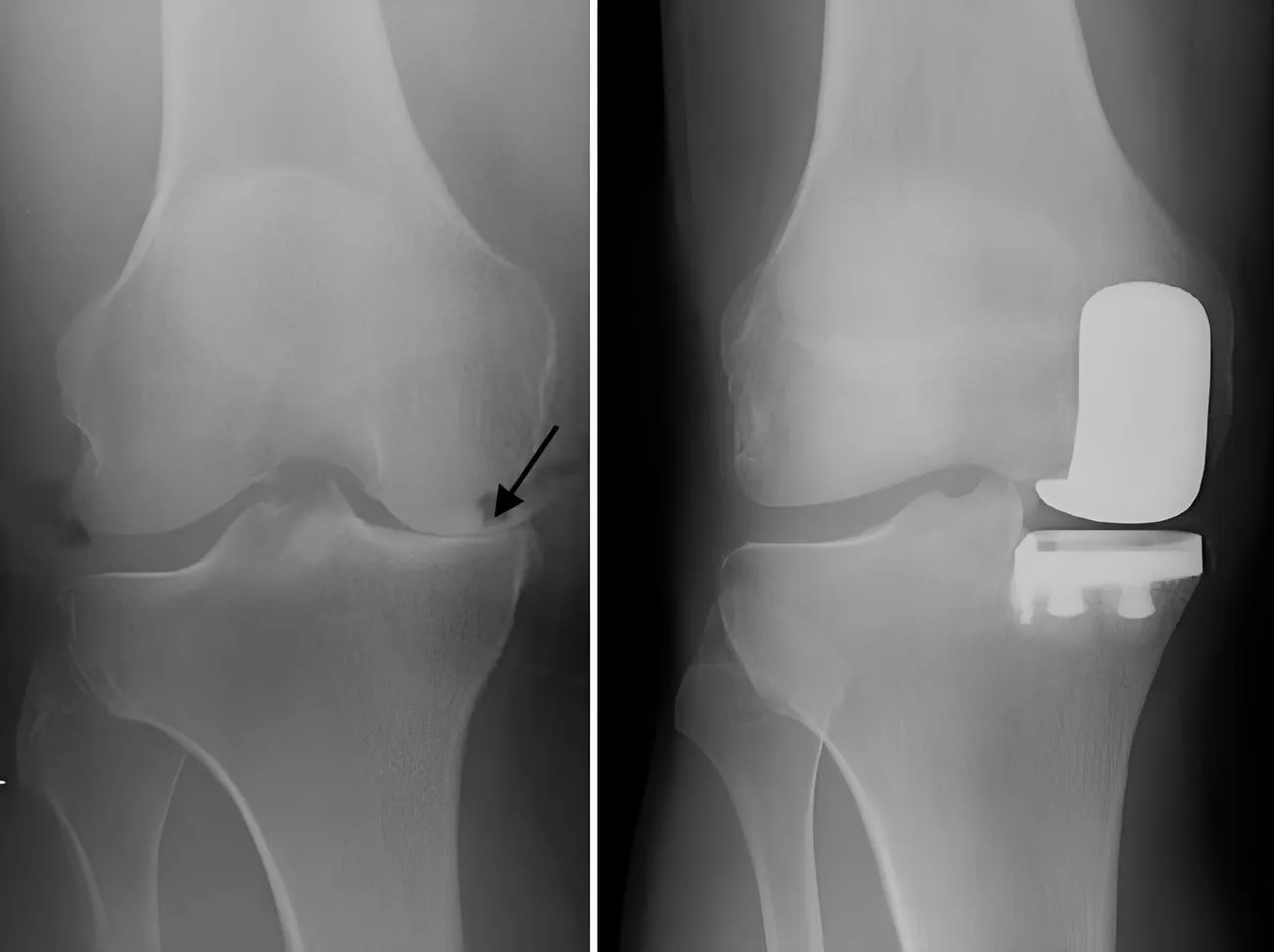 Knee Replacement