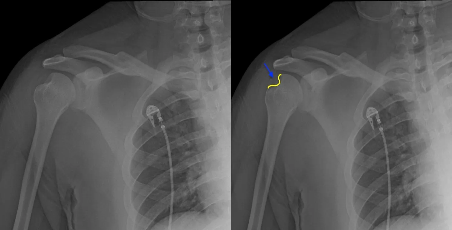 Recurrent Shoulder Dislocation
