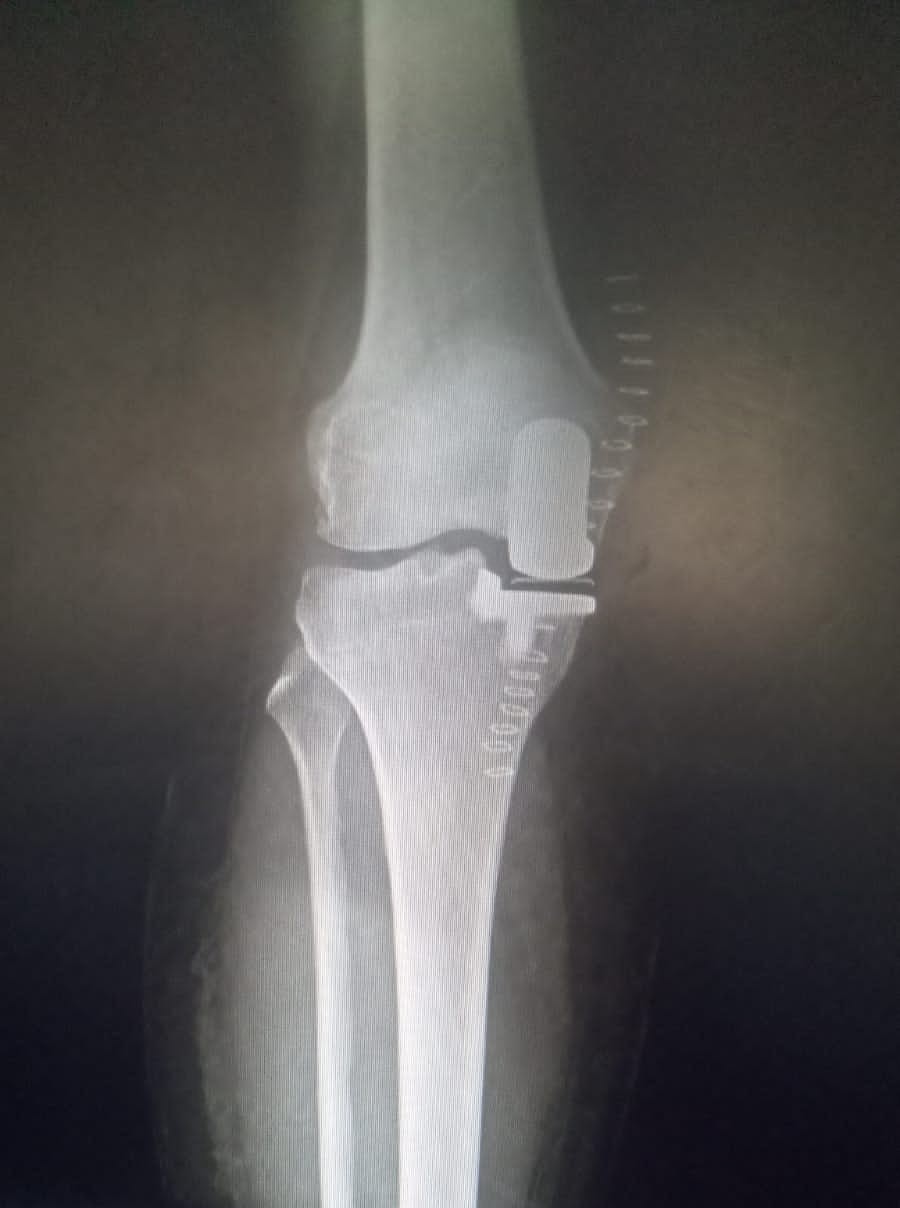 Unicondylar knee replacement